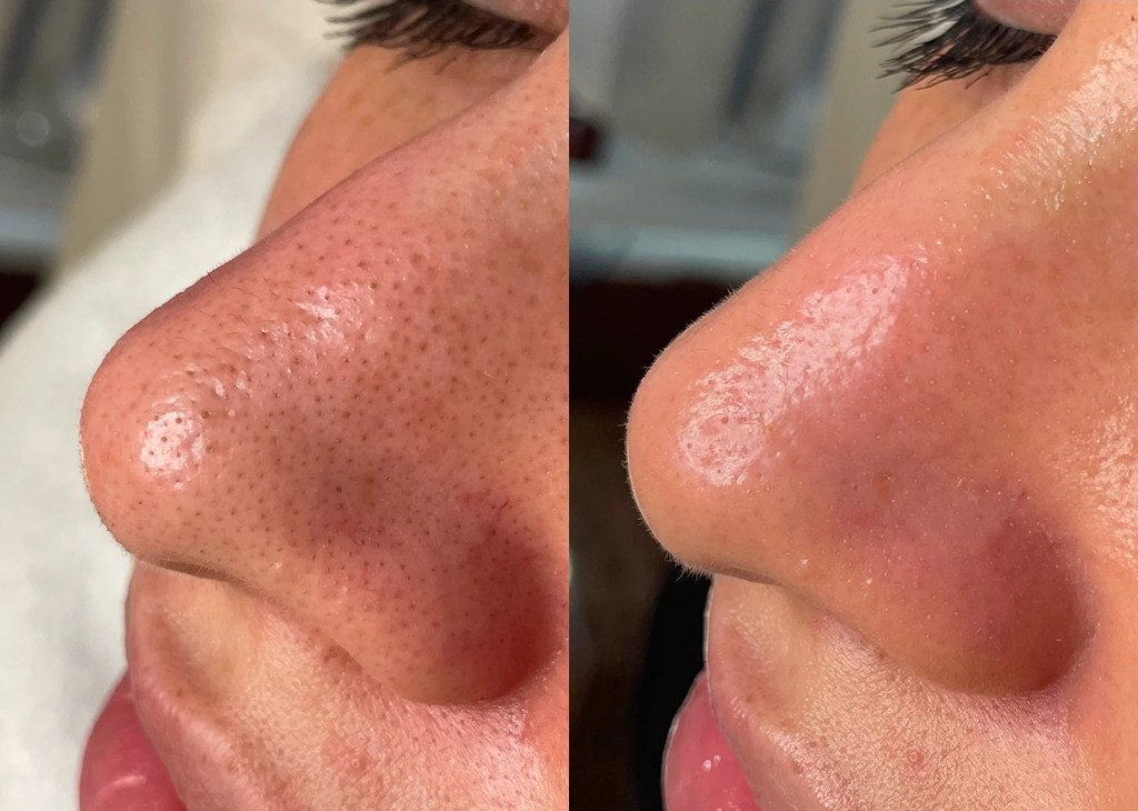 Hydrafacial 
