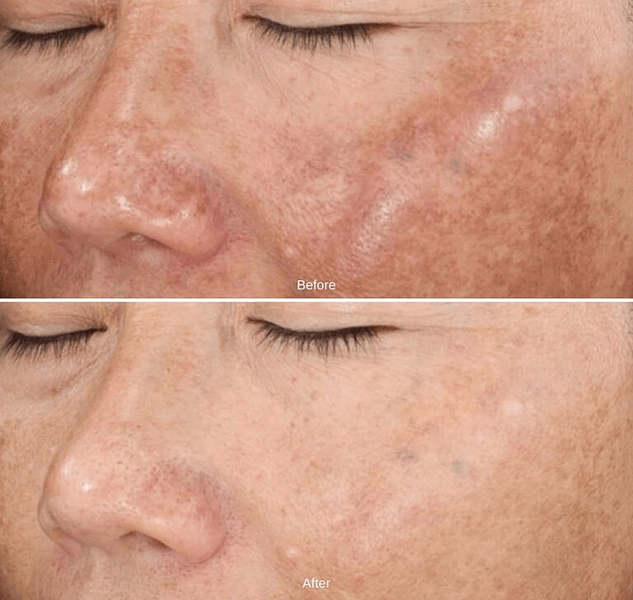 chemical peels Naples FL
