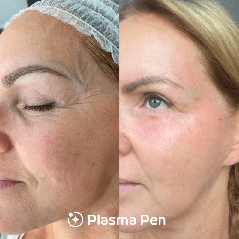Fibroblast Skin Tightening
